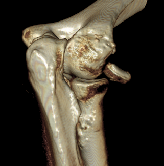 CT Radial Head Fracture
